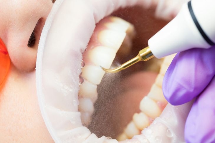 Does Teeth Cleaning Loosen Your Tooth?