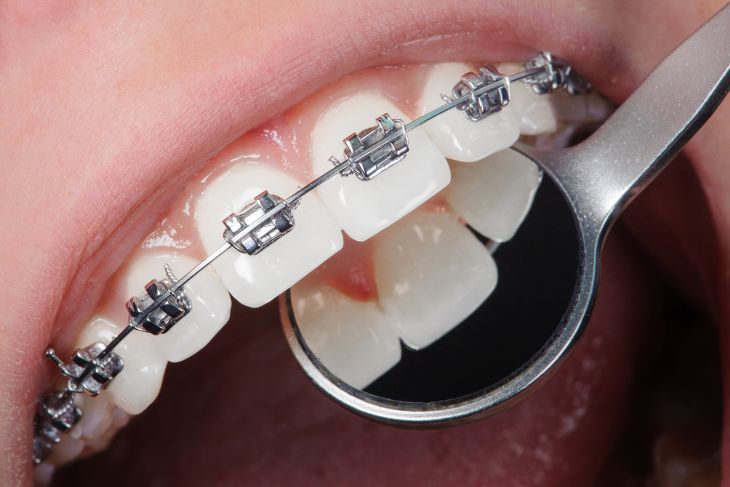 Myths About Gum Disease