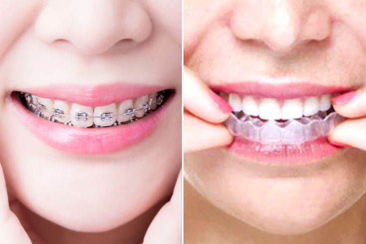 Comparison Between Traditional Braces Treatment And Newer Clear Aligners
